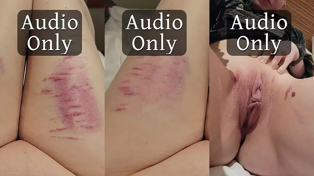 еще больше красивых синяков и история о том, как они у меня появились