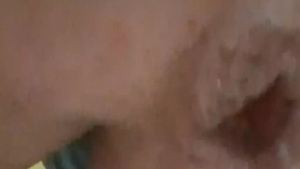 я дрочу свои геморроидальные узлы и довожу их до выпадения